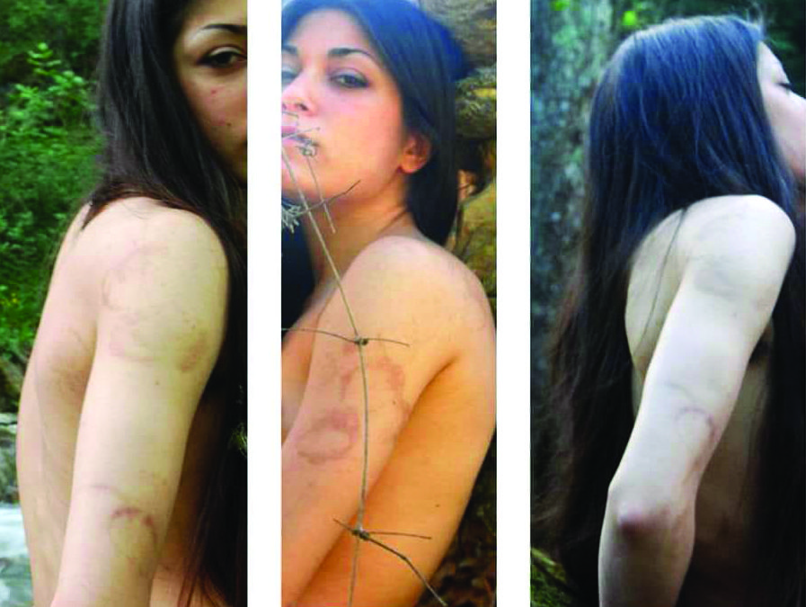 Marinella Meligeni mostra le cicatrici e i segni dei maltrattamenti