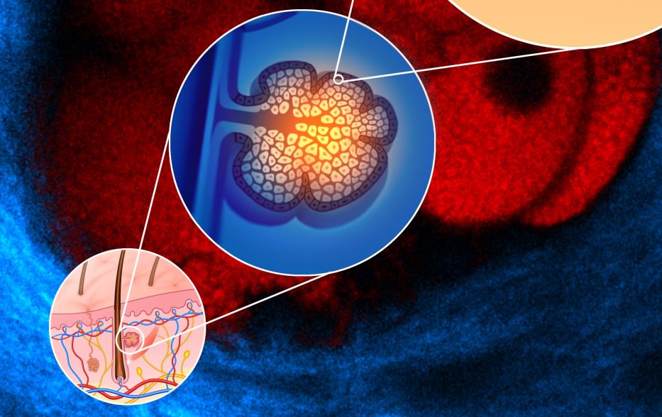 Salute, un anticorpo monoclonale per contrastare sindrome di Clouston