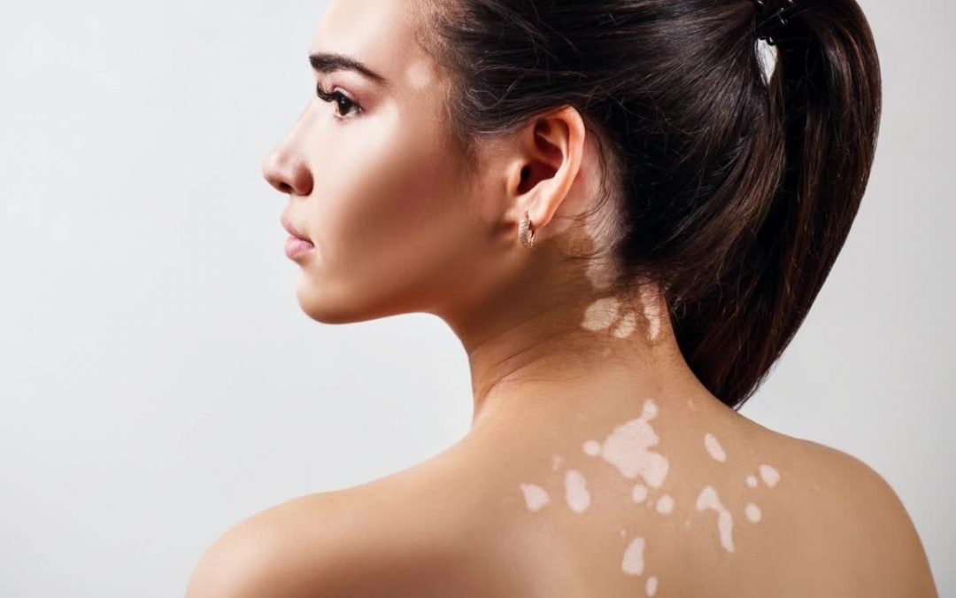Vitiligine, la cura è più vicina