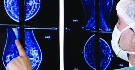 Prevenzione tumore al seno, in Puglia in 200mila dicono «no» al test