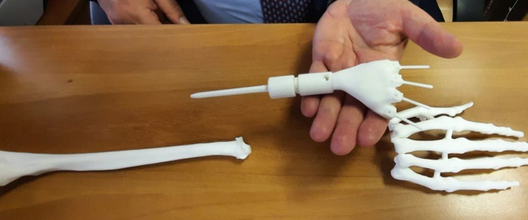 Un polso realizzato con una stampante 3D salva la mano di una neo-mamma
