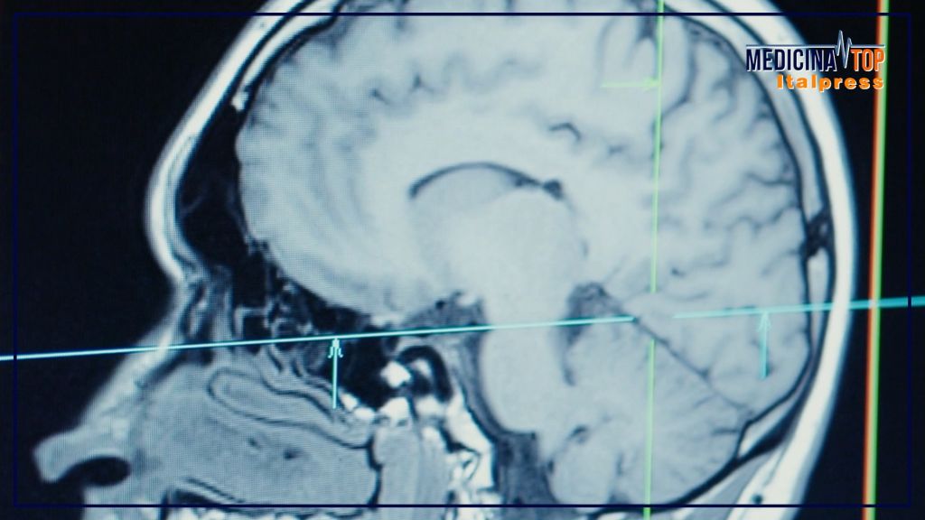 Ultrasuoni focalizzati, alta tecnologia al servizio della neurochirurgia