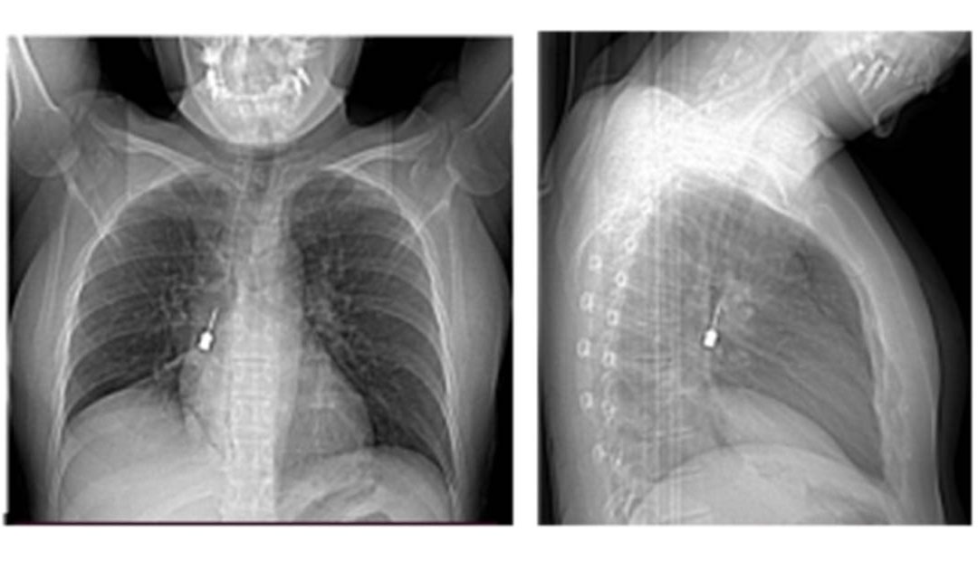 L'esame tomografico che evidenzia la presenza del cacciavite odontoiatrico nei bronchi