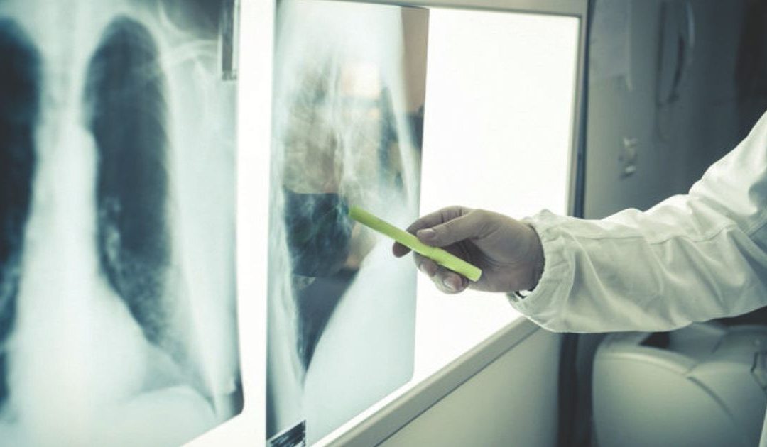 Basilicata, cancro alla mammella, più cure fuori regione