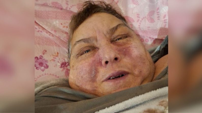 A Pizzo donna immobilizzata a letto e senza assistenza