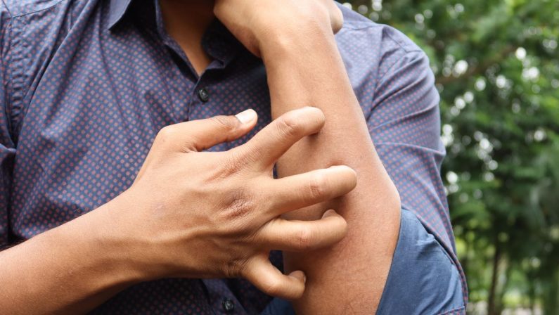 Studio Novartis, l’orticaria cronica spontanea costa 4.200 euro l’anno a paziente