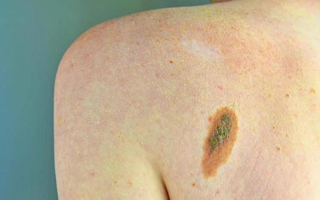 Imi: “Bene legge su prevenzione melanoma, educare i giovani su rischi”