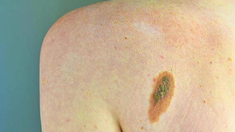 Melanoma, Adoi: “Bene nuova legge su prevenzione, dermatologo centrale in screening”