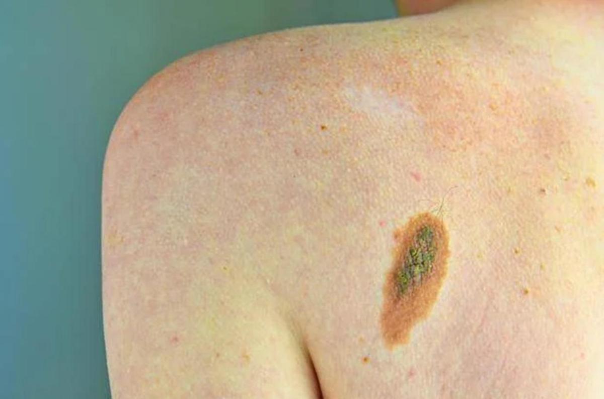 https://www.quotidianodelsud.it/wp-content/uploads/2026/06/melanoma-free-rit.jpeg