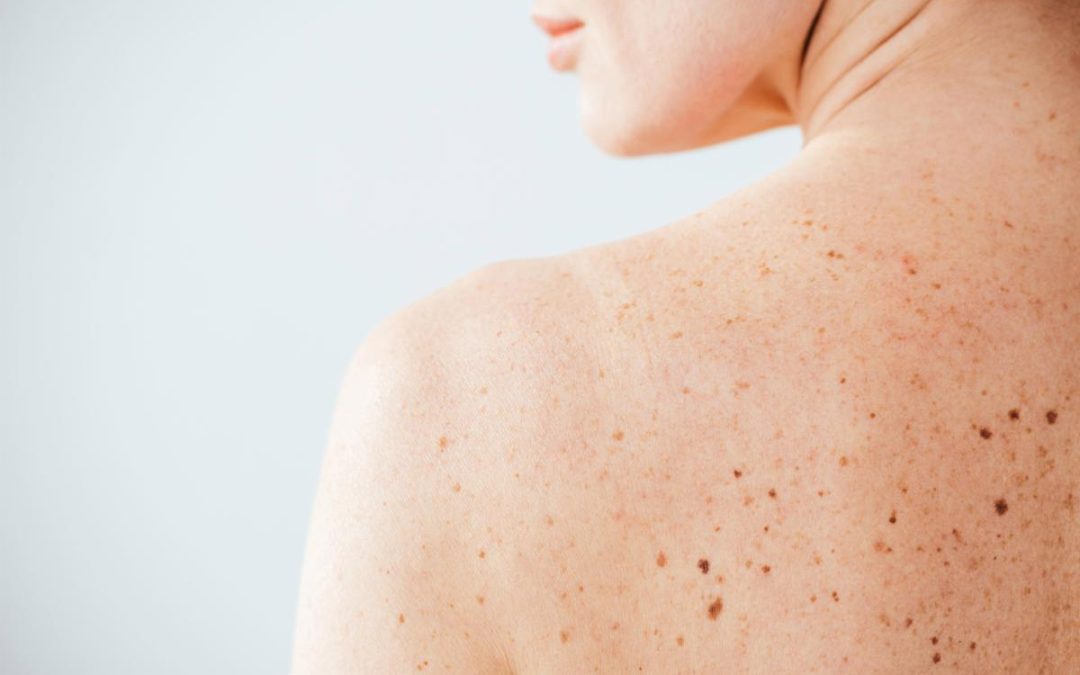 Nei e sole, Sidemast lancia la Giornata della prevenzione dermatologica