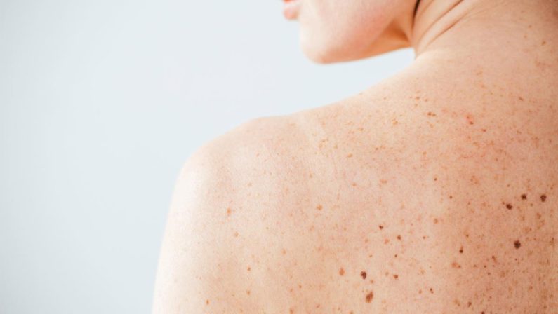 Nei e sole, Sidemast lancia la Giornata della prevenzione dermatologica