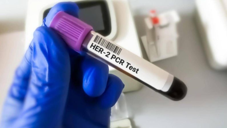 Tumore gastroesofageo Her2+, risultati positivi per tislelizumab con zanidatamab e chemio