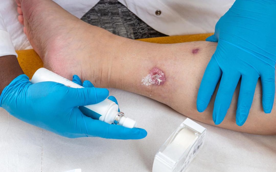Idrosadenite suppurativa, le iniziative di Ucb per migliorare diagnosi e cura