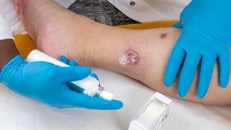 Idrosadenite suppurativa, le iniziative di Ucb per migliorare diagnosi e cura