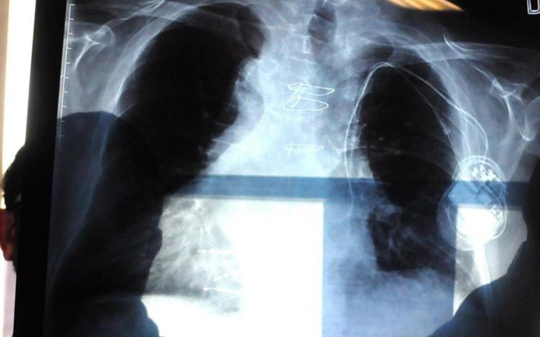 Bpco, pneumologa Foschino Barbaro: “Nella donna sintomi diversi, attenzione alle giovani”