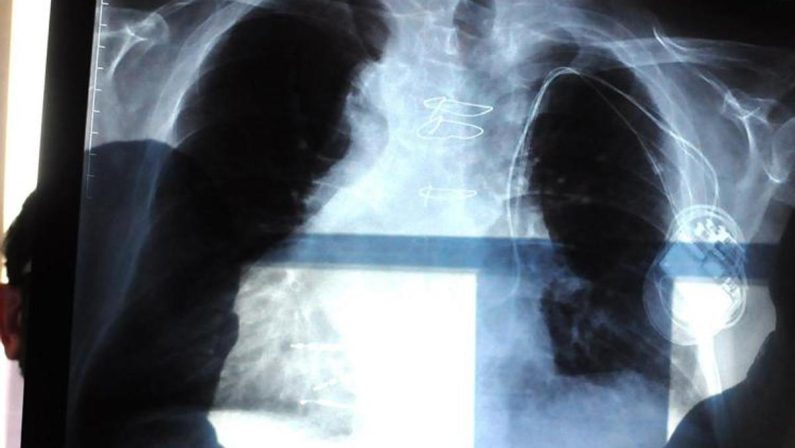 Bpco, pneumologa Foschino Barbaro: “Nella donna sintomi diversi, attenzione alle giovani”