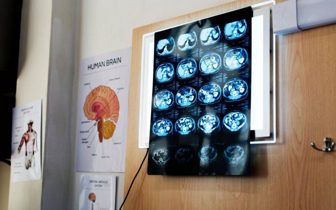 Di Battista, cosa indica un mal di testa forte e improvviso: le ipotesi del neurologo