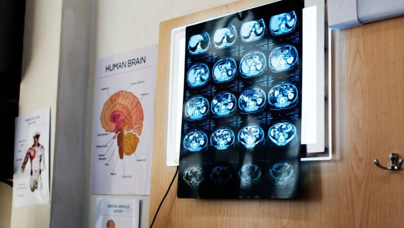 Di Battista, cosa indica un mal di testa forte e improvviso: le ipotesi del neurologo