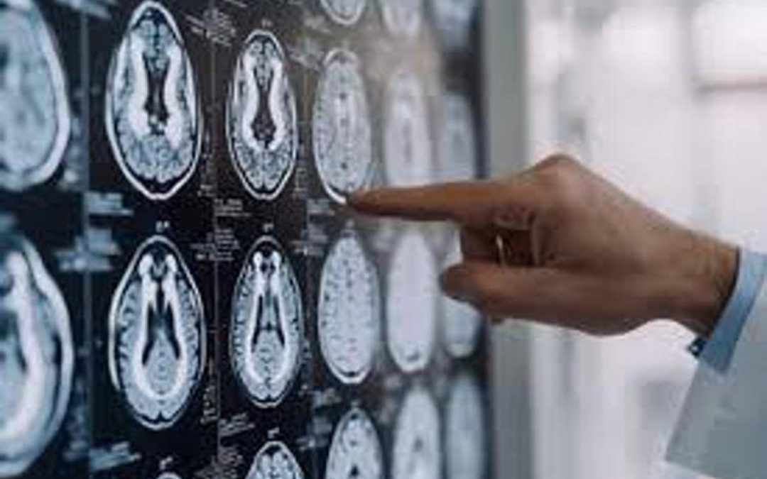 Malattia di Parkinson, ok in Europa a formulazione orale Ld/Cd a rilascio modificato