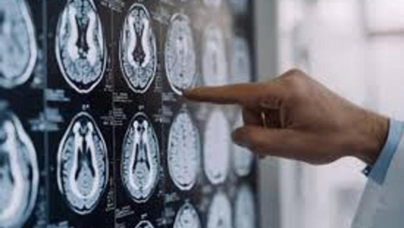 Malattia di Parkinson, ok in Europa a formulazione orale Ld/Cd a rilascio modificato