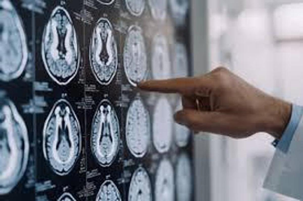 https://www.quotidianodelsud.it/wp-content/uploads/2026/08/parkinson-fg.jpeg