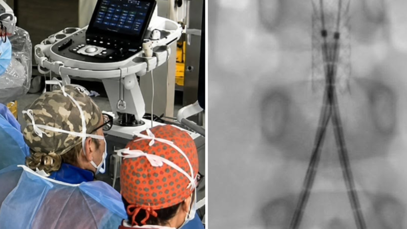 Incidente con un’acquasantiera in chiesa, bimba di 6 anni operata d’urgenza all’aorta a Bari