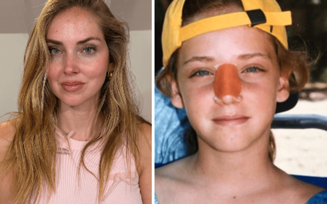 Chiara Ferragni, l’intervento al naso: “Ecco perché è storto ora”
