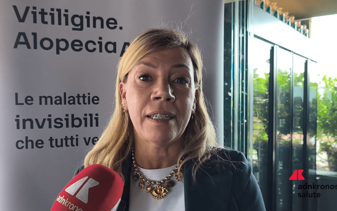 Cordella (AbbVie): “Vitiligine e alopecia siano riconosciute da Ssn”