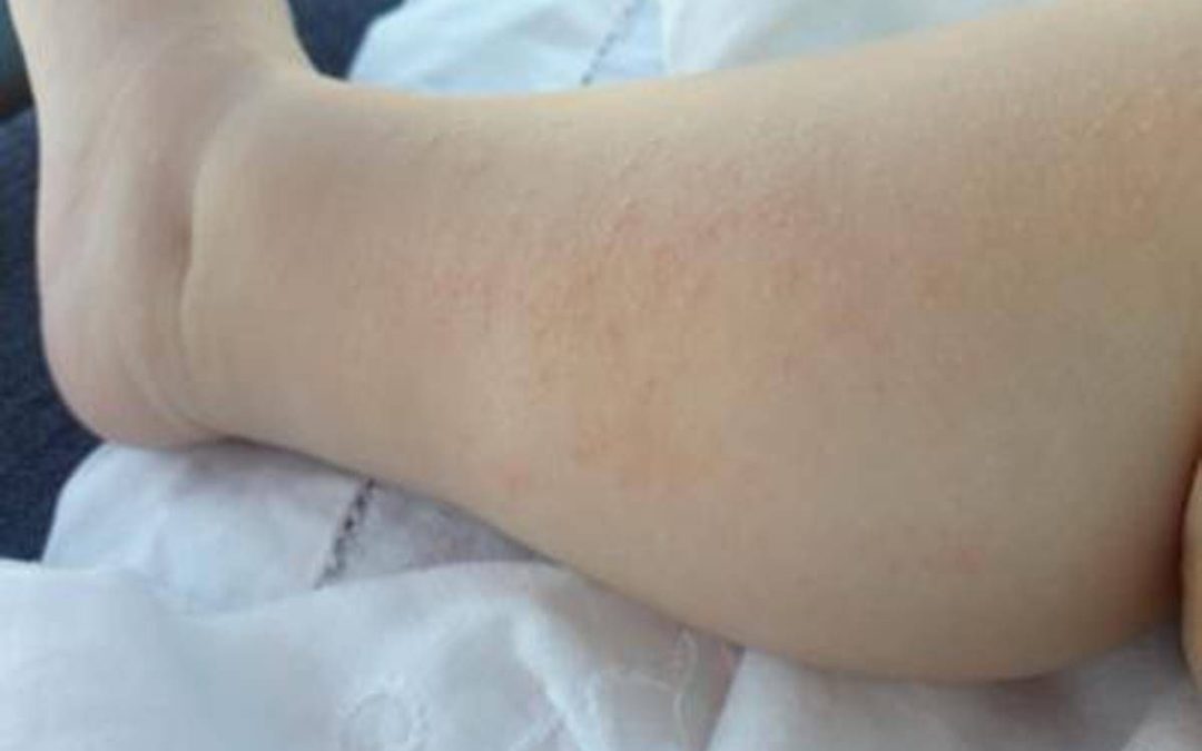 Dermatite atopica, Aifa estende rimborso di upadacitinib dai 12 anni di età