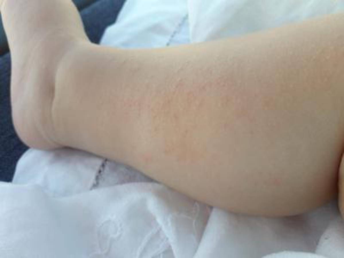 https://www.quotidianodelsud.it/wp-content/uploads/2026/09/dermatite-atopica-adn.jpeg