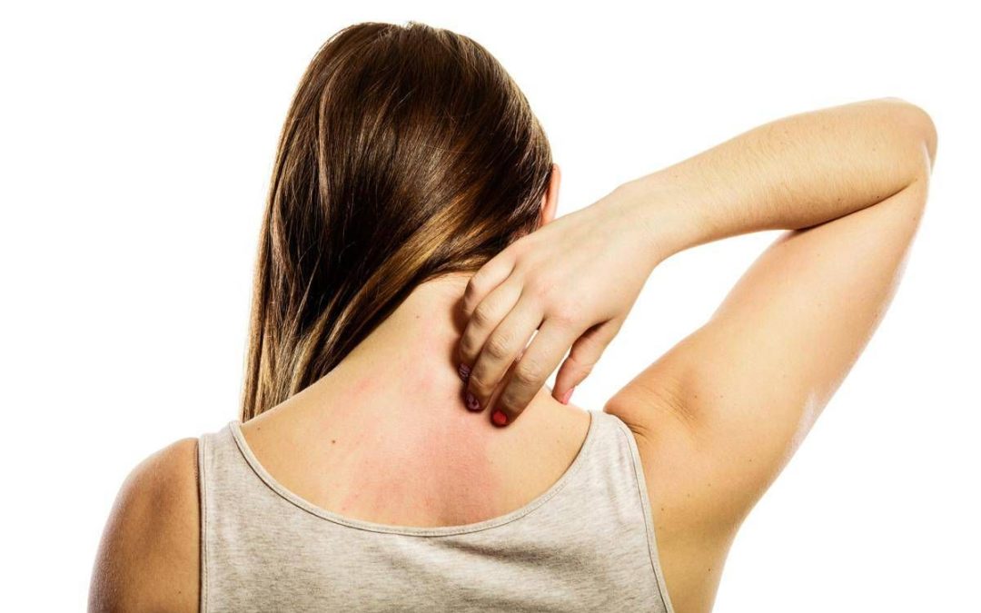 Linfoma cutaneo a cellule T, esperta: “Diagnosi difficile per sintomi dermatologici”