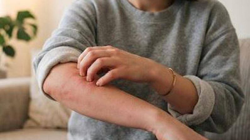 Malattia della pioggia, perché se ne parla: cos’è e sintomi