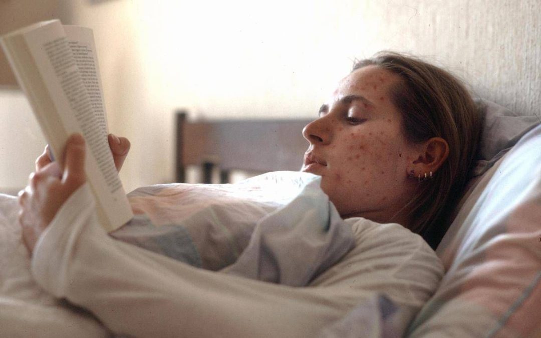 Morbillo, l’appello di Pregliasco: “Può avere effetti gravi, bisogna prevenire contagio”