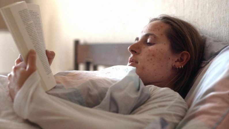 Morbillo, l’appello di Pregliasco: “Può avere effetti gravi, bisogna prevenire contagio”