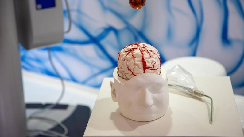 Dai gliomi al Parkinson, così l’intelligenza artificiale aiuta la Neurochirurgia