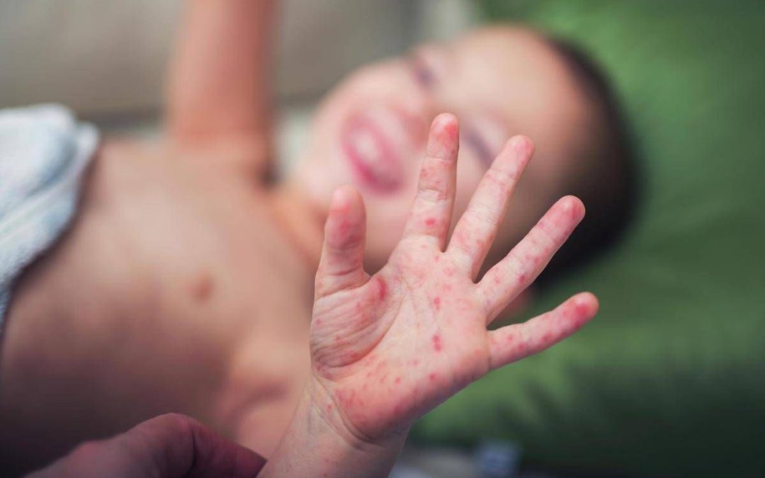 Morbillo, aumentano casi e ricoveri. Bassetti: “In Liguria focolaio senza precedenti, l’Italia rischia gravissima epidemia”