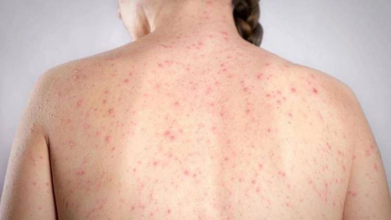 Morbillo, l’allarme dell’infettivologo Andreoni: “Casi in crescita, ricoveri frequenti negli adulti”