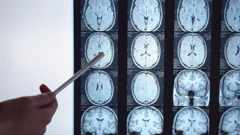 Di Battista e il tumore al cervello, in Italia circa 6mila diagnosi ogni anno: quali sono i sintomi ‘spia’