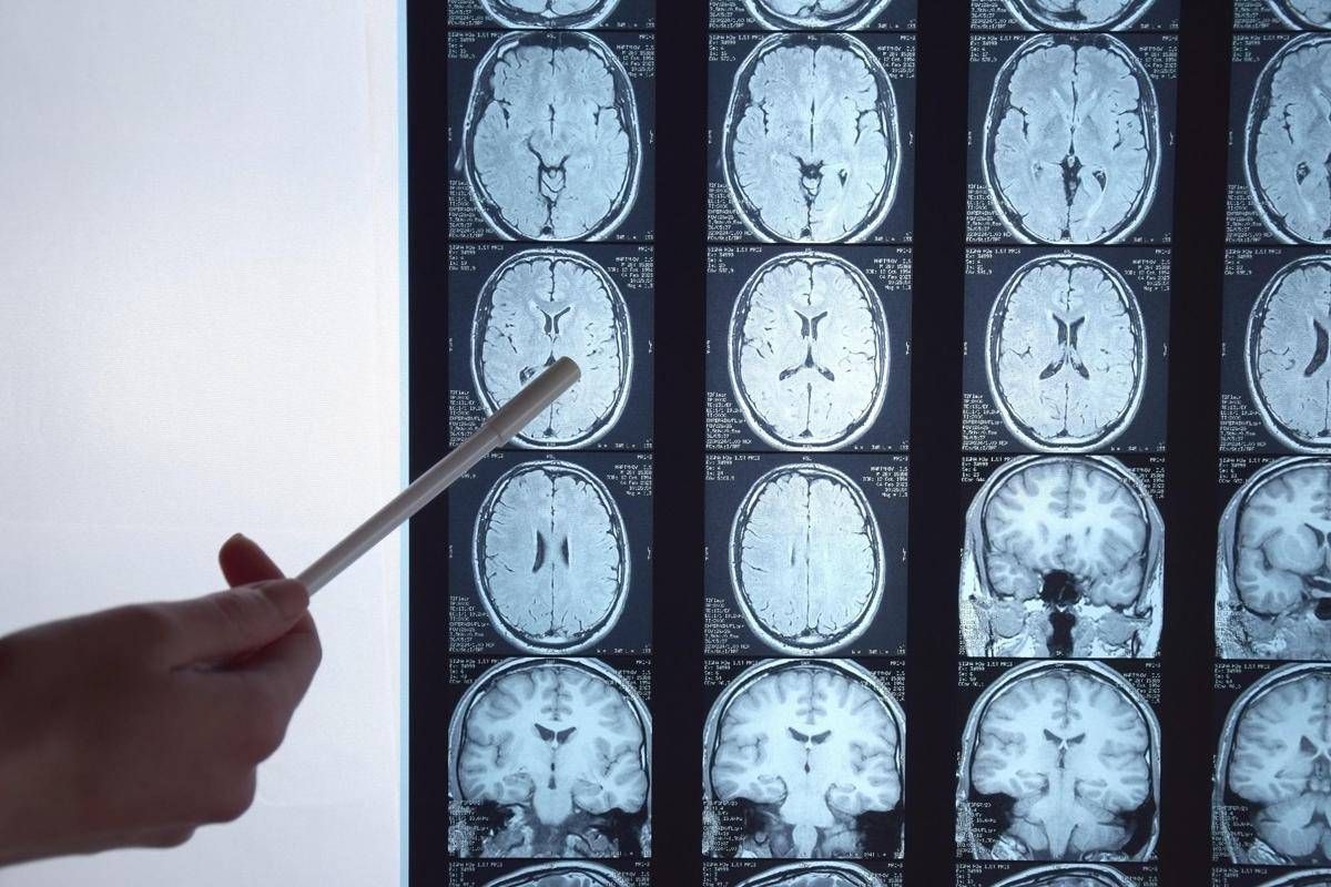 https://www.quotidianodelsud.it/wp-content/uploads/2026/09/radiografia-cervello-123rf.jpeg