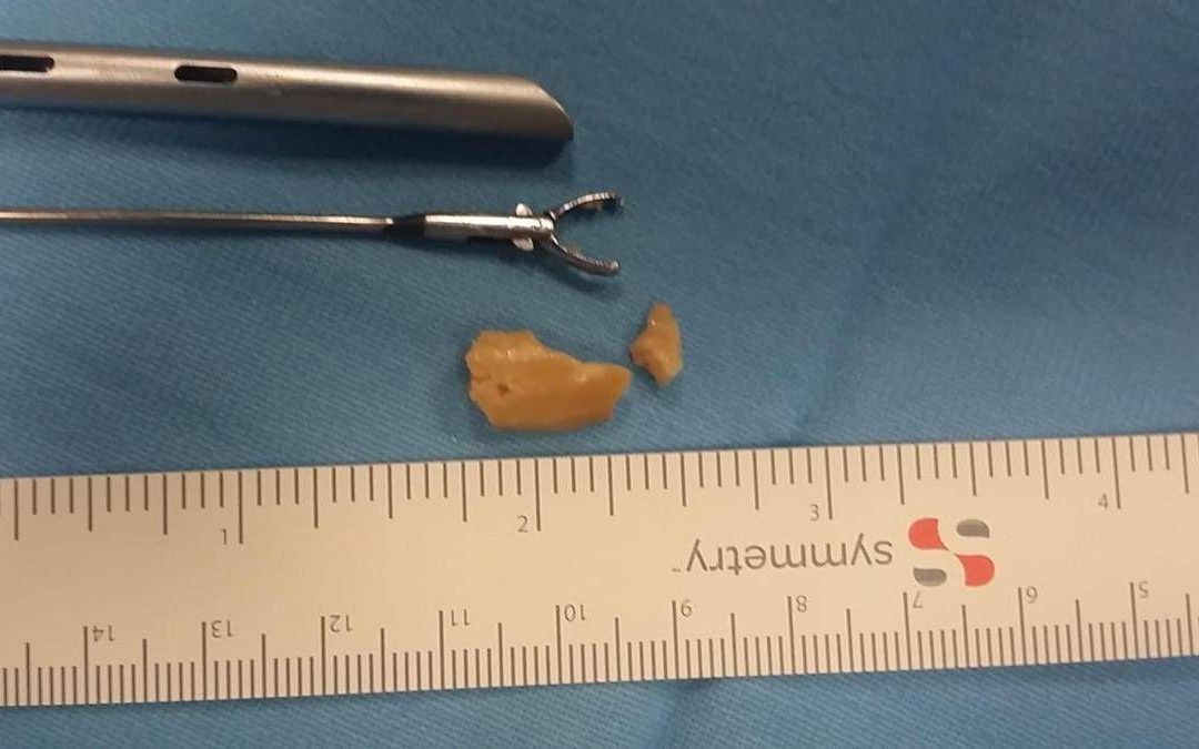 Aveva una nocciola bloccata nei bronchi da due settimane, salvata bimba di 20 mesi