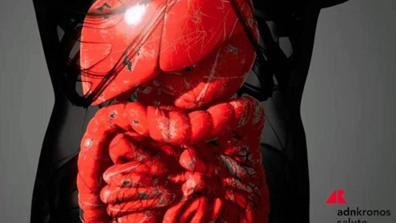 Malattie infiammatorie intestinali, rimborsabile guselkumab per colite ulcerosa e Crohn