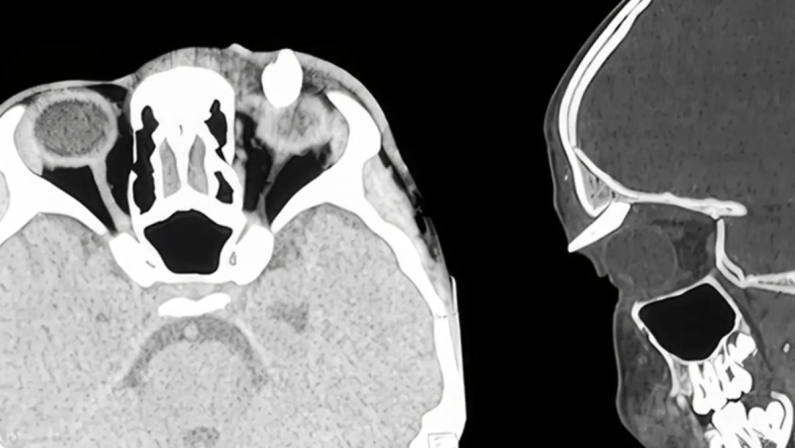 Ha un gonfiore sotto l’occhio, in ospedale scoprono che ha un dente nella palpebra: lo strano caso in India