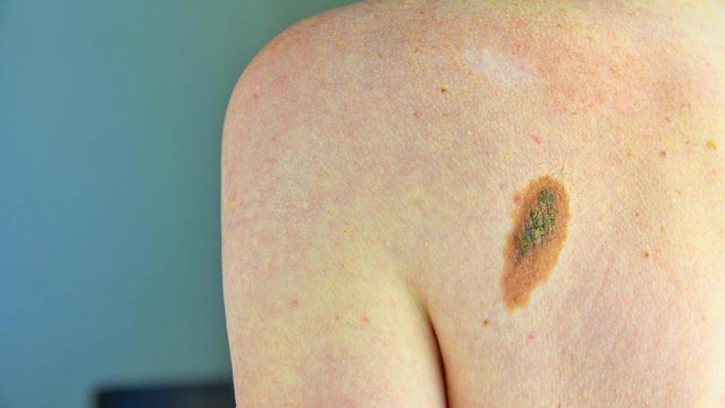 Melanoma, la firma mutazionale del cancro potrà cambiare la cura﻿