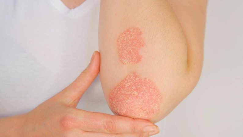 Giornata psoriasi, Ucb rinnova l’impegno contro lo stigma