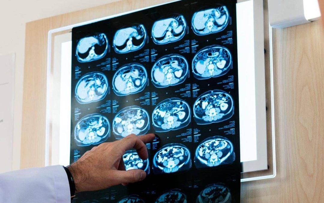 Nodulo polmonare: che cos’è, come si diagnostica e quando intervenire
