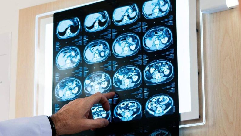 Nodulo polmonare: che cos’è, come si diagnostica e quando intervenire