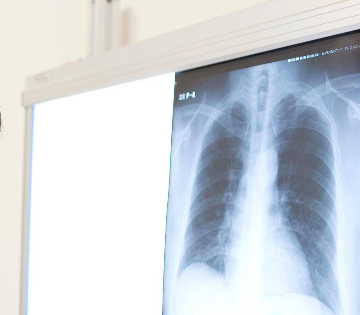 https://www.quotidianodelsud.it/wp-content/uploads/2026/10/radiografia-polmone-123rf-free.jpeg