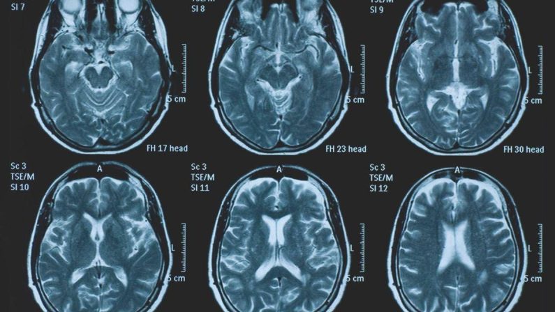 Una persona su 3 ha un disturbo neurologico, a Napoli arriva BrainSpace House