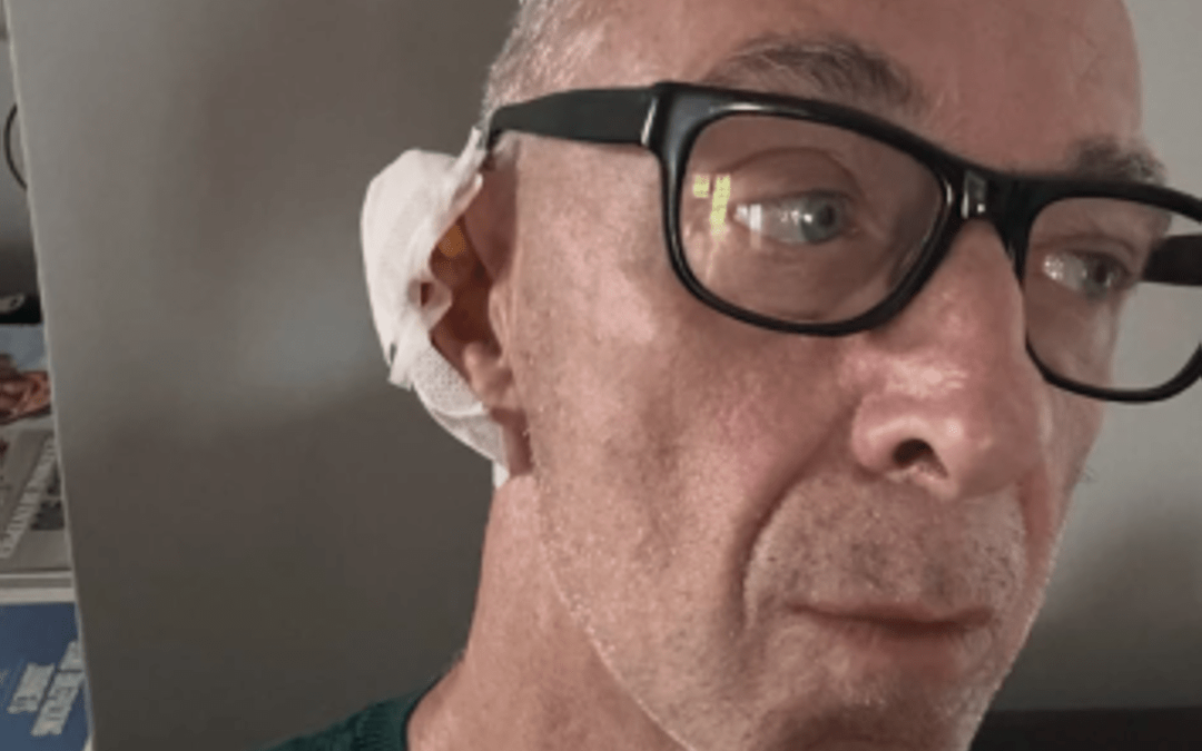 Linus ha una malattia della pelle: “Si chiama Epitelioma”. Di cosa si tratta