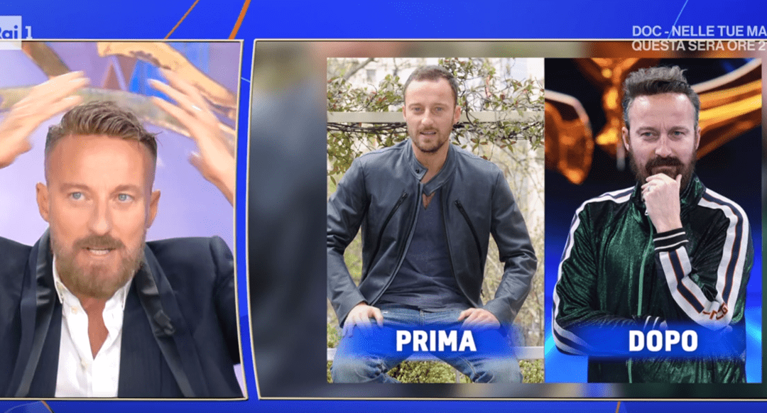 Francesco Facchinetti, la battaglia contro la calvizie: “Ho trovato la pace con una patch cutanea”